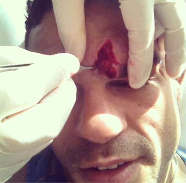 Vitor Belfort tem o supercílio suturado dez dias antes de enfrentar Michael Bisping (Foto: Reprodução/Instagram)