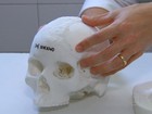 Impressora 3D ajuda a reconstruir crânios e muda vida de pacientes