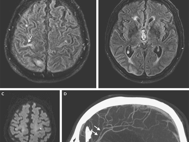 Vírus foi detectado no líquido cefalorraquídeo, encontrado no cérebro e medula espinhal (Foto: The New England Journal of Medicine/Reprodução)