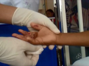 Menino realiza curativos diariamente em hospital (Foto: Reprodução/TV Amapá)
