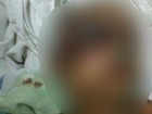 Menino agredido em Sítio Novo ainda não tem previsão de alta hospitalar