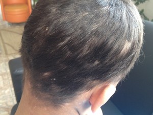 Menina de 11 anos teve que cortar os cabelos para retirada das larvas (Foto: Fernanda Borges/G1)