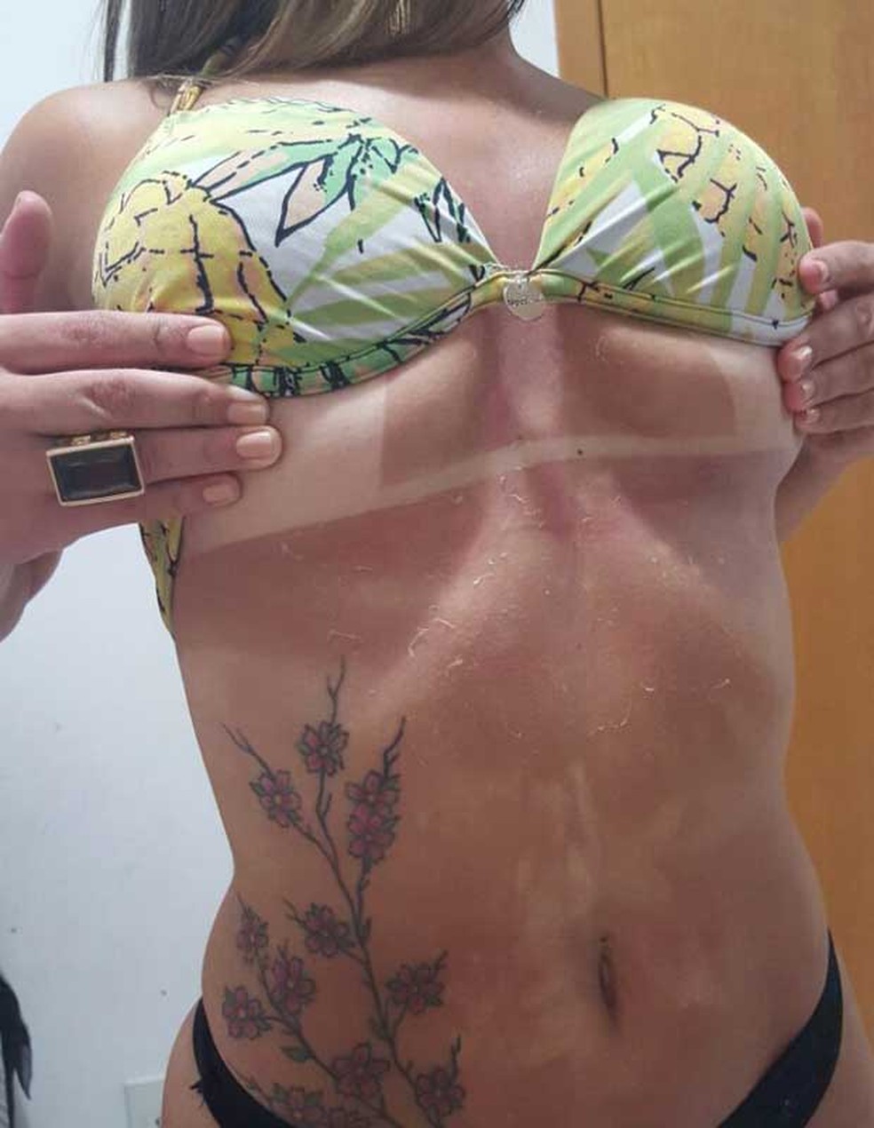 Marcas na barriga da ex-candidada a Miss Continente DF Blenda Soares após sessão de bronzeamento natural (Foto: Blenda Soares/Arquivo Pessoal)