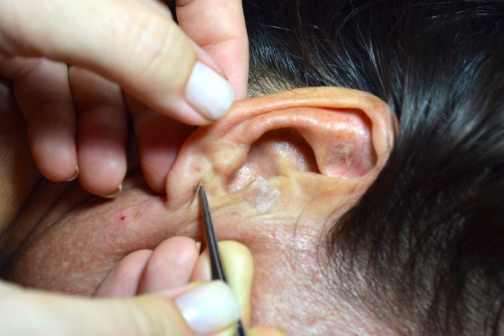 Acupuntura 2