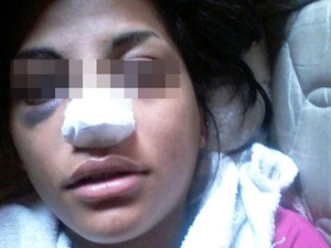 Jovem agredida durante assalto afirma que ainda está com o nariz quebrado (Foto: Arquivo Pessoal)