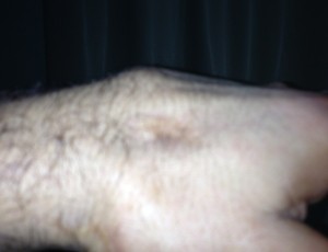 Mão lesionada de Vitor Belfort (Foto: Divulgação/Twitter)