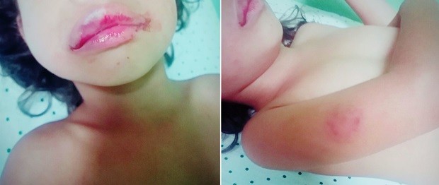 Imagens mostram que criança ficou com hematomas na boca e no braço (Foto: Divulgação/Polícia Civil)