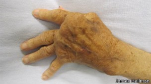 Pessoas com artrite reumatoide desenvolvem inflamações nas articulações (Foto: BBC)