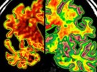 Cientistas detectam mal de Alzheimer antes dos sintomas aparecerem