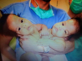 Siameses antes de entrar na sala de cirurgia para instalar expansor de pele (Foto: Katherine Coutinho/G1)