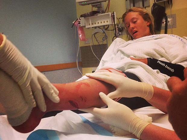 Kirra-Belle Olsson recebe tratamento no hospital, após ter sido atacada por tubarão enquanto surfava nesta sexta-feira (17) (Foto: Divulgação/Kirra-Belle Olsson/ Facebook)