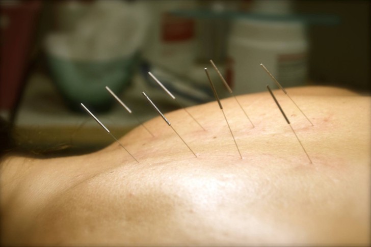 Acupuntura 1