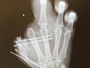 Jogador da NFL troca foto de perfil por raio-x de mão mutilada por acidente
