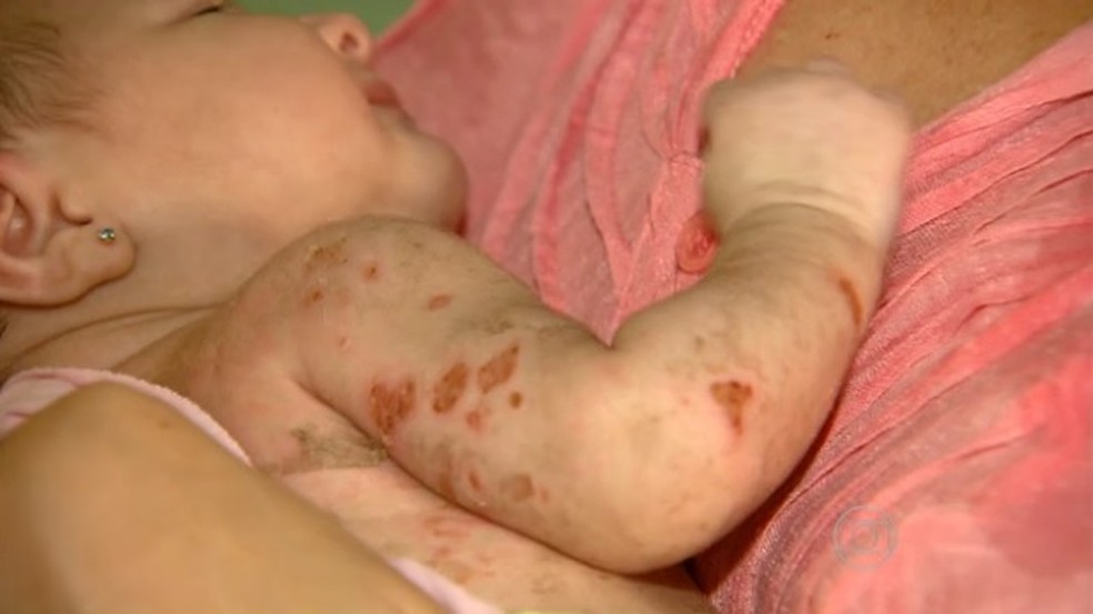 Bolhas em bebês são causadas pela chikungunya (Foto: Reprodução/TV Globo)