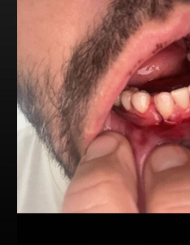Henri Castelli relata agressões e mostra ferimentos (Foto: Reprodução/Instagram)