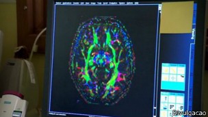 Ressonância magnética de cérebro de adolescente (Foto: Divulgação/BBC)