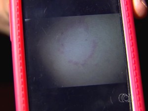 Foto em celular mostra marca de mordida no corpo de adolescente que diz ter sofrido estupro coletivo em Indiara, Goiás (Foto: Reprodução/TV Anhanguera)