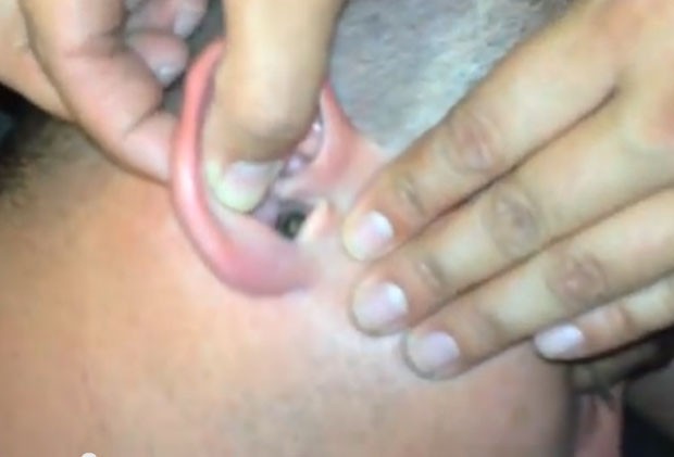 Vídeo mostra grupo grupo de amigos ajudando a retirar mariposa de ouvido de homem (Foto: Reprodução/YouTube/Jacob Stanfield)