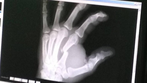 Radiografia mostra dedo de Wilians Santos quebrado após luta no HCC 13 (Foto: Divulgação/Arquivo Pessoal)