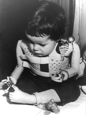 Criança alemã deformada pela talidomida na década de 1960 (Foto: AP Photo/Arquivo)