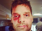 Ricky Martin assusta fãs com foto de 'machucados'
