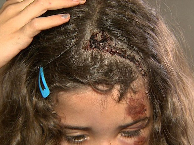 Luana de Paula Ferreira da Silva levou 14 pontos na cabeça após o acidente (Foto: Reprodução/EPTV)