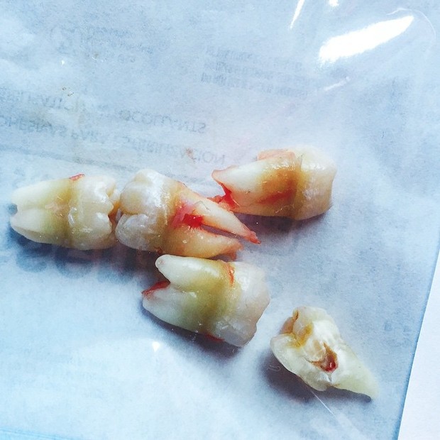 Ego Que Dor Miley Cyrus Arranca Os Sisos E Mostra Fotos Noticias De Ego Teen