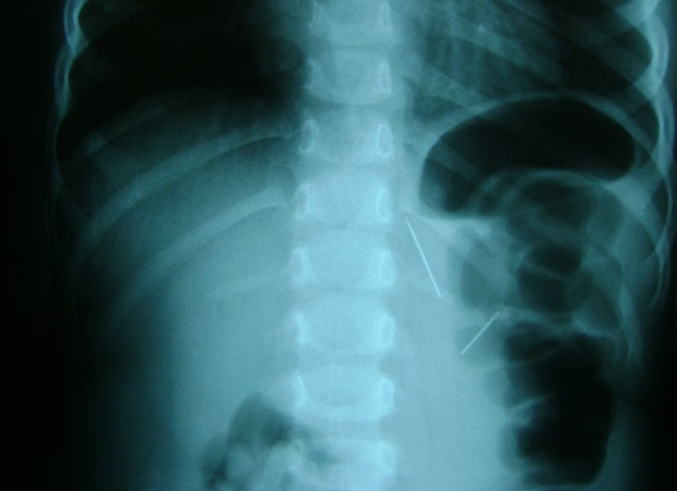 Raio X mostra agulha partida próximo à coluna vertebral, abaixo do pulmão (Foto: Karoline Zilah/G1)