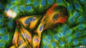 Melanoma câncer de pele (Foto: BBC)