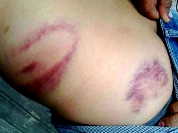 Jovem diz ter sido agredida com cassetete (Foto: Francinéia Melo/ Arquivo pessoal)