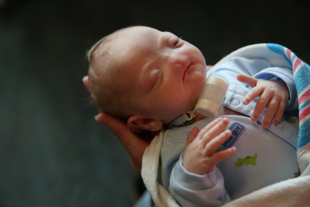 Timothy Eli nasceu sem nariz: condição é rara  (Foto: AP Photo/AL.com, Sharon Steinmann)