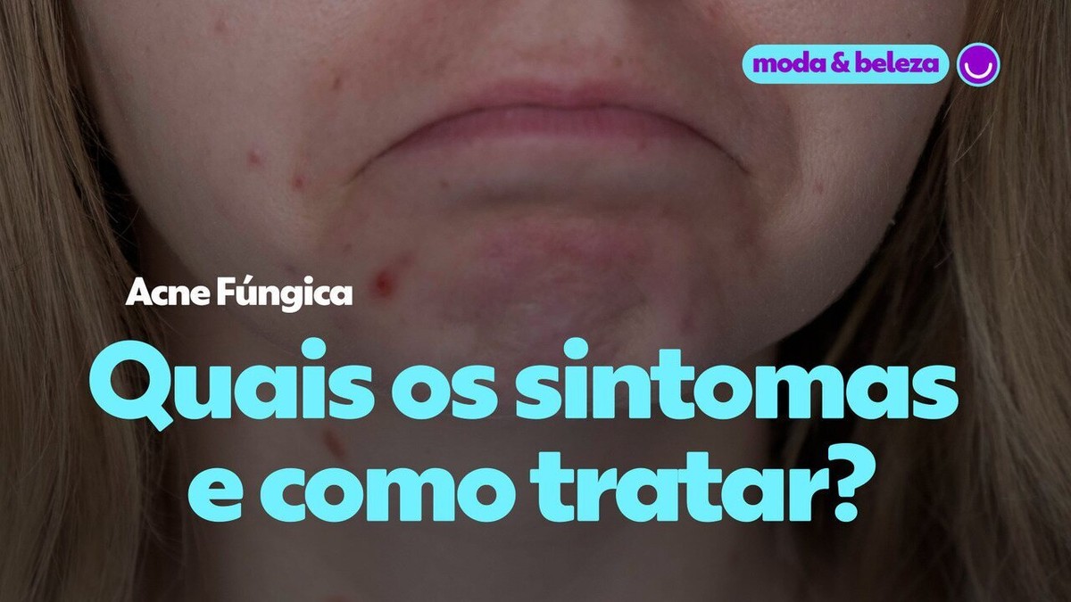 Acne Fúngica o que é quais os sintomas e como tratar Moda Beleza