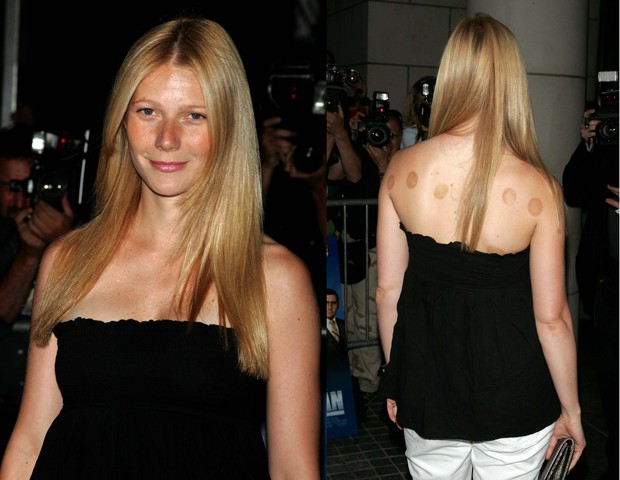 Gwyneth Paltrow com marcas de cupping nas costas em um evento em 2004 (Foto: Jim Spellman / WireImage / Getty Images)