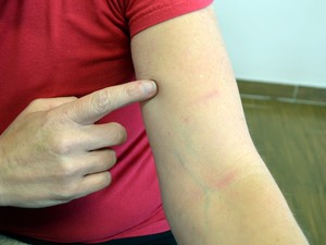 Cliente ficou com marcas no braço após agressão em mercado de Piracicaba (Foto: Fernanda Zanetti/G1)