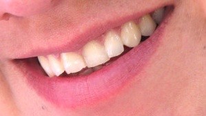 Dentes sorriso (Foto: WikiCommons)