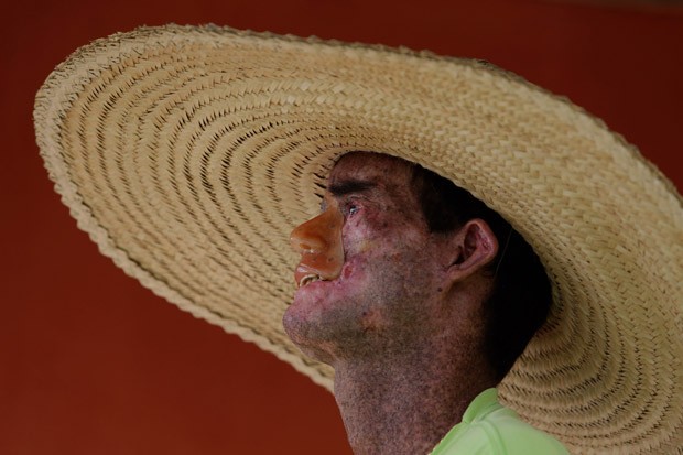 Por causa do xeroderma, Djalma Antônio Jardim quase não sai de casa, em Araras, distrito de Faina, Goiás (Foto: Eraldo Peres/AP)