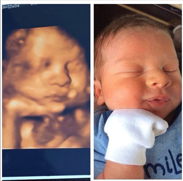 Bebês: antes e depois (Foto: Reprodução / Instagram)