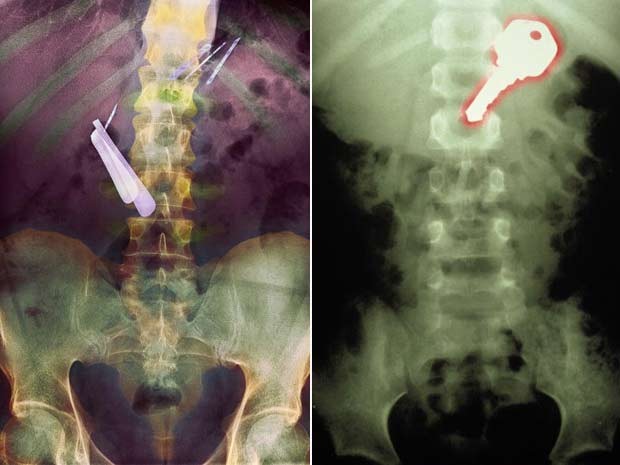 À esquerda, raio-X mostra lâminas de barbear que foram engolidas por um paciente. À direita, imagem mostra uma chave que foi engolida por um menino de 7 anos (Foto: Barcroft Media/Getty Images)