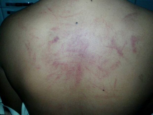 Adolescente ficou com ferimentos nas costas após briga em escola em Piracicaba (Foto: Valter Valverde/Arquivo pessoal)