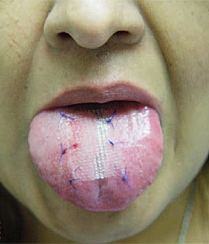 Foto mostra paciente com tela costurada na língua. (Foto: Paul Chugay/Divulgação)