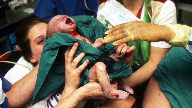Com 52% dos partos feitos por cesarianas - enquanto o índice recomendado pela OMS é de 15% -, o Brasil é o país recordista desse tipo de parto no mundo (Foto: BBC)