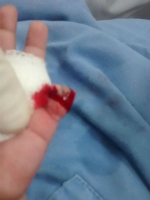 Bebê teve dedo cortado na segunda-feira (12) (Foto: Jaqueciane Moraes/Arquivo pessoal)