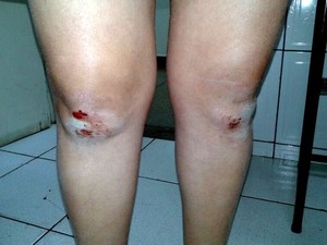 Mãe de adolescente teve ferimentos na perna após briga em escola em Piracicaba (Foto: Valter Martins/Piracicaba em Alerta)