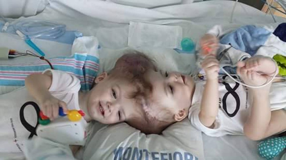 Gêmeos siameses Jadon e Anias McDonald passaram por uma cirurgia de separação em outubro (Foto: Reprodução/Facebook/Nicole McDonald)