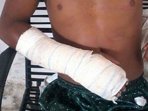 Homem mostra o braço que teria sido quebrado durante tortura (Foto: Arquivo Pessoal)
