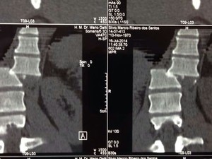 Radiografis mostra coluna de Sílvio quebrada em duas partes (Foto: Digitalização/Arquivo Mário Gatti)