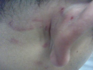 Jovem mostra orelha machucada após agressão em shopping (Foto: Divulgação/Arquivo pessoal)