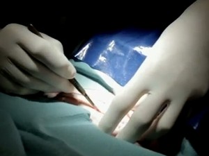 Vídeo mostra pele do artista sendo retirada por cirurgião para ser colocada no anel (Foto: Reprodução)