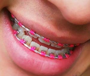 Jovens usam acessórios dentários de maneira irregular (Foto: Aparelhos Diferenciados/Divulgação/Facebook)