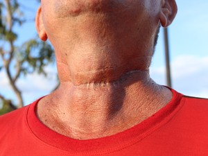 Antônio Barbosa teve um corte profundo na garganta (Foto: Ellyo Teixeira/G1)